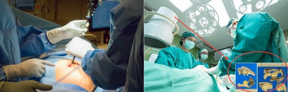 Оперирование яичника