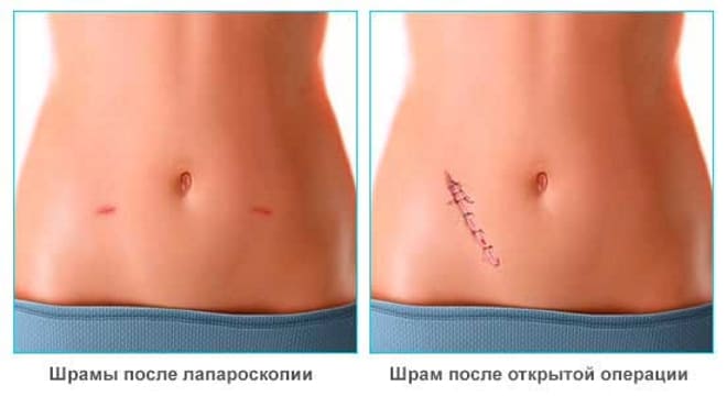 Швы и рамы после лапаротомии и лапароскопии