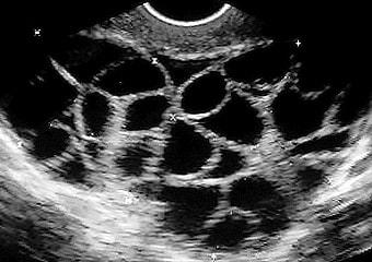 Гиперстимуляция придатков матки на УЗИ