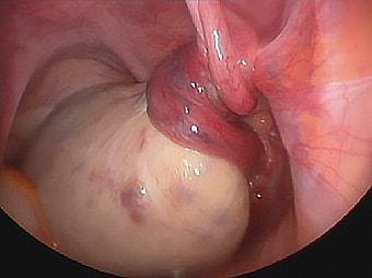 Ножка кисты яичника перекручена