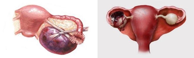 Перекрут ножки кисты и разрыв яичника
