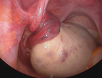 Перекрученная ножка кисты яичника при беременности