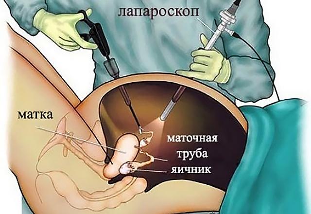 Как проходит операция лапароскопии яичников