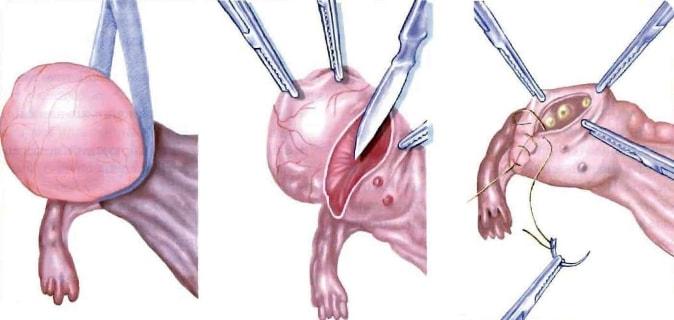 Как проводится клиновидная резекция яичника