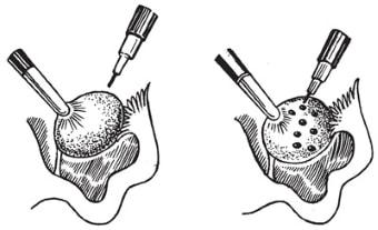 Каутеризация яичников