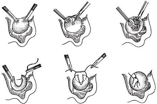 Повторная клиновидная резекция
