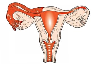 Симптомы аднексита