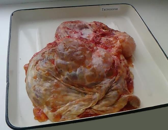 Псевдомуцинозная кистома яичника на фото