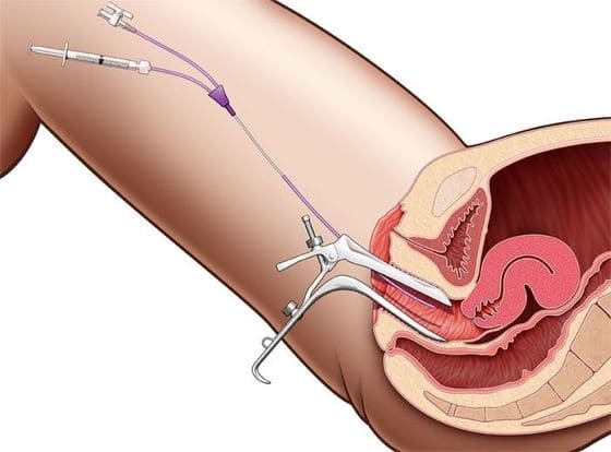 Проведение пункции заднего свода при беременности