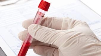 Сдача крови при гипертекозе яичников