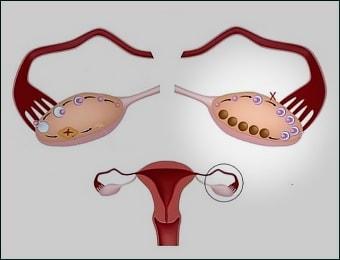 Фото мультифолликулярных женских парных половых органов