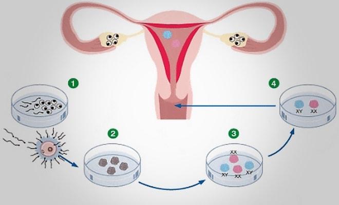 Поэтапный цикл искусственного оплодотворения
