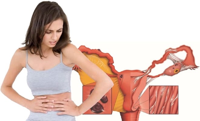 Спайки при воспалении придатков