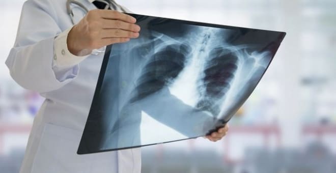 Подозрение на туберкулёз