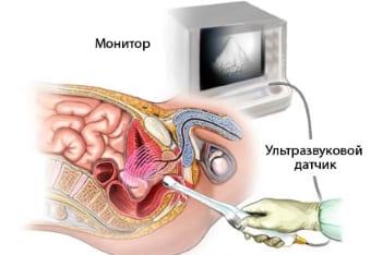 Трансвагинальное УЗИ после родов