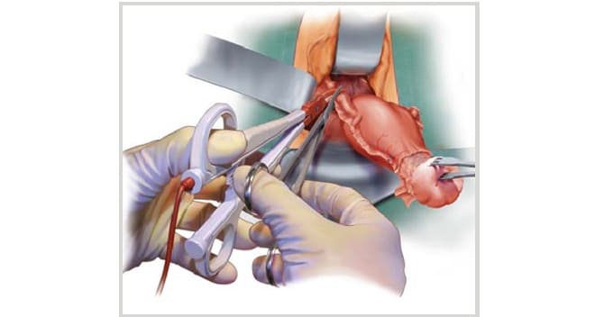 Методика проведения влагалищной гистоэктомии