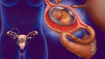 Апоплексия при внематочной беременности