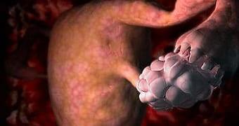 Временная дисфункция женских придатков