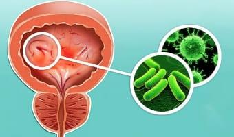 Хронический женский цистит