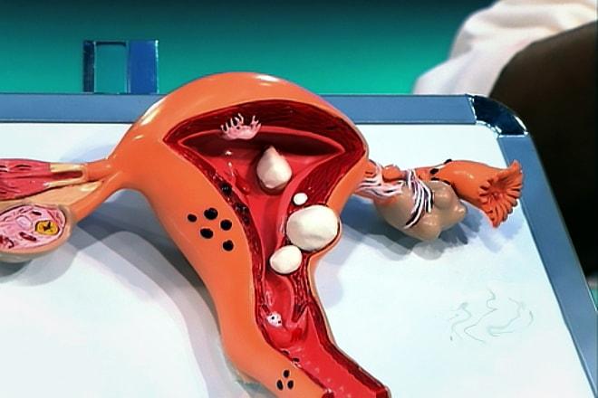 Фото миомы матки