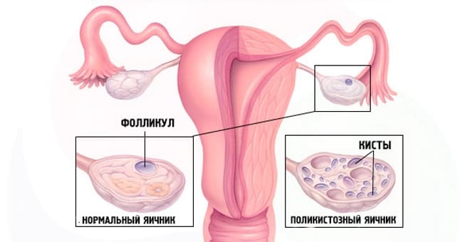 Яичник с поликистозом и без него